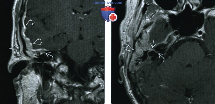 Метастазы в основании черепа - лучевая диагностика