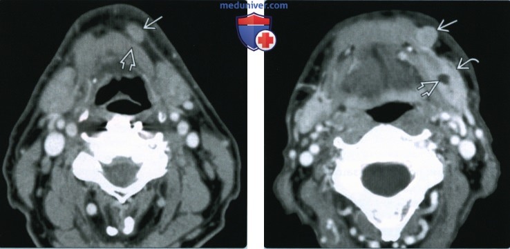 Метастазы плоскоклеточного рака в поднижнечелюстные лимфоузлы - лучевая диагностика