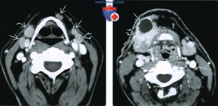 Метастазы плоскоклеточного рака в поднижнечелюстные лимфоузлы - лучевая диагностика