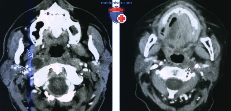 Метастазы плоскоклеточного рака в заглоточные лимфоузлы - лучевая диагностика