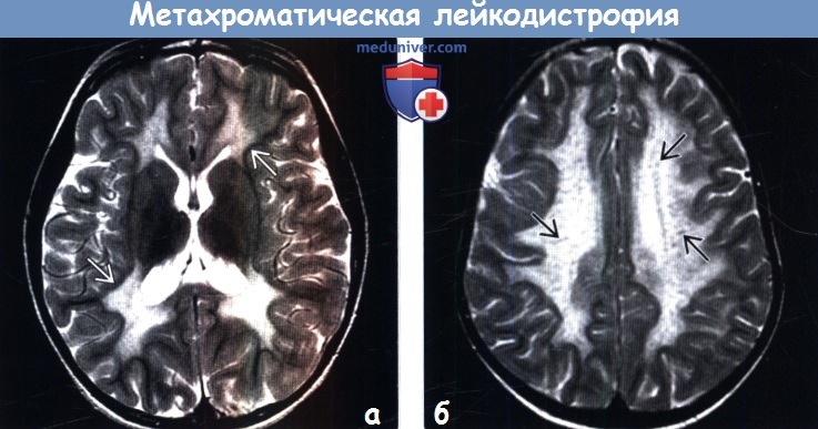 Лейкодистрофия это. Лейкодистрофия головного мозга. Пелицеуса-Мерцбахера. Метахромная лейкодистрофия.