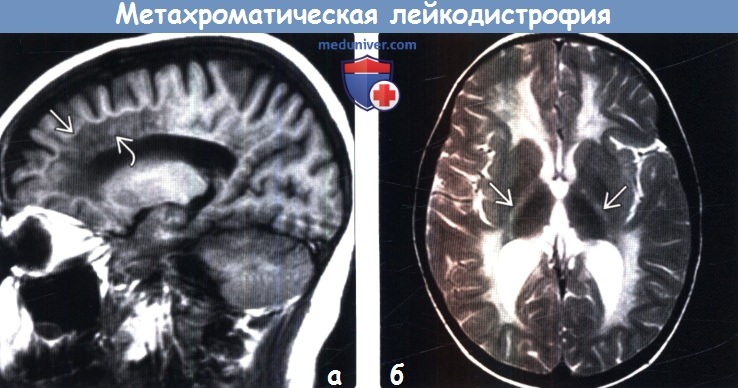 Метахроматическая лейкодистрофия на МРТ головного мозга