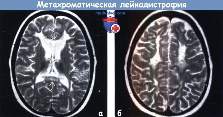 Метахроматическая лейкодистрофия на МРТ головного мозга
