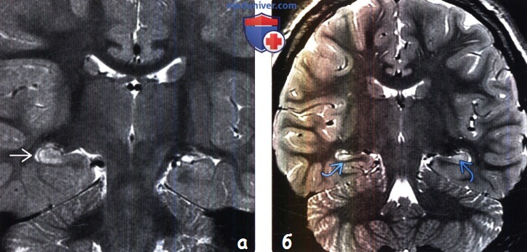 Мезиальный височный склероз на МРТ головного мозга