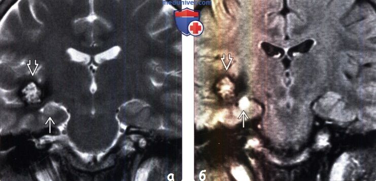 Мезиальный височный склероз на МРТ головного мозга
