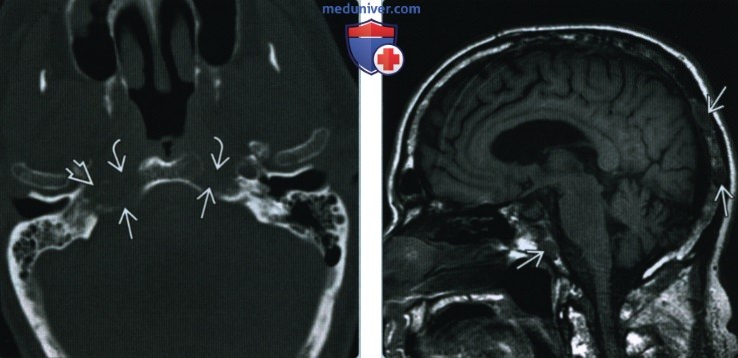 Миеломная болезнь основания черепа - лучевая диагностика