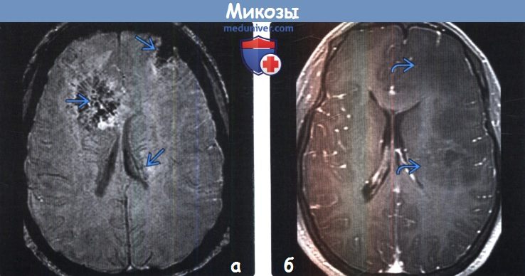 Микозы головного мозга на МРТ