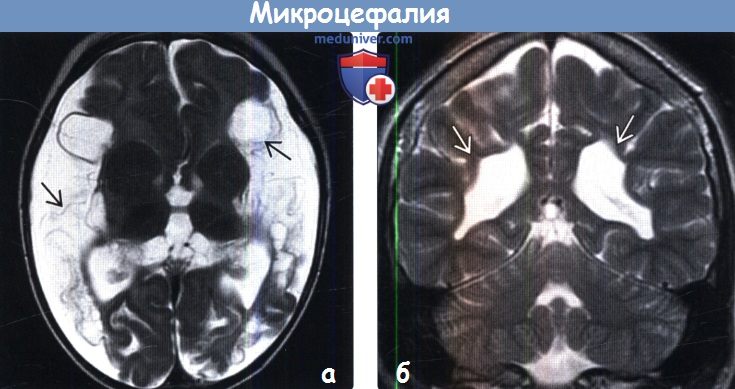 Мрт мозга фото при микроцефалии thumbnail