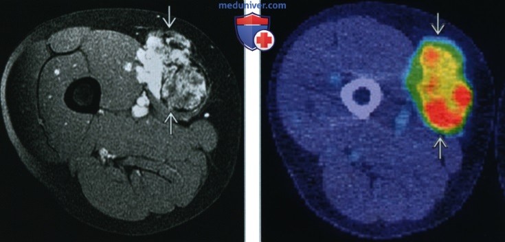 Внескелетная миксоидная хондросаркома - лучевая диагностика