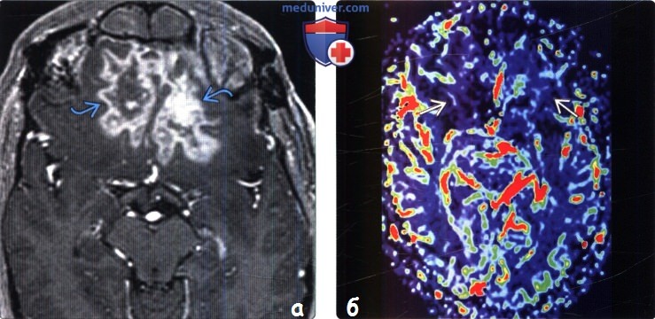 Поражение головного мозга после лучевой терапии и химиотерапии на МРТ