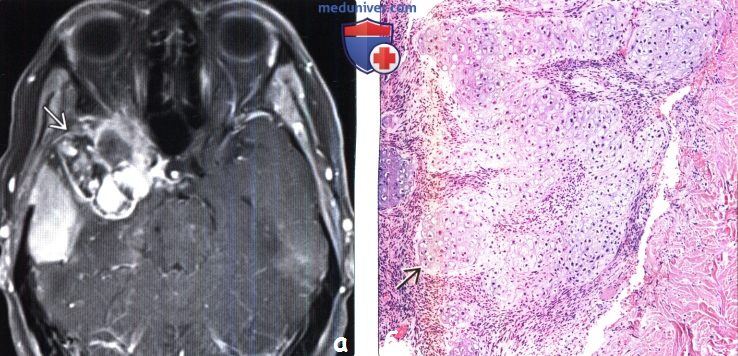 Поражение головного мозга после лучевой терапии и химиотерапии на МРТ, под микроскопом
