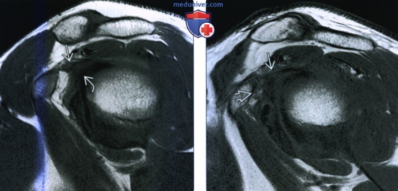 МРТ при адгезивном капсулите плечевого сустава