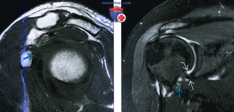 МРТ при адгезивном капсулите плечевого сустава