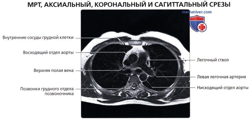 МРТ анатомия грудной клетки в норме