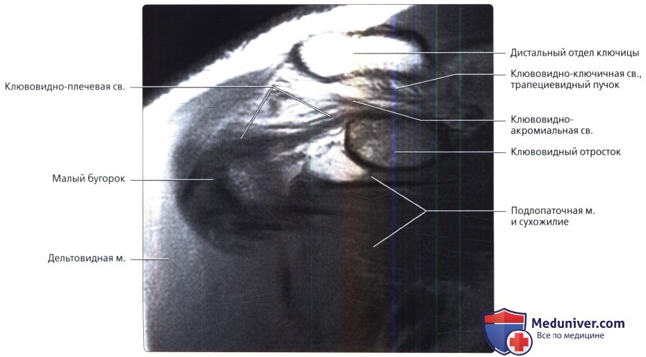 МРТ, артрограмма связок плечевого сустава в норме