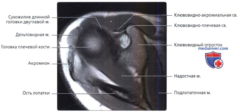 МРТ, артрограмма связок плечевого сустава в норме