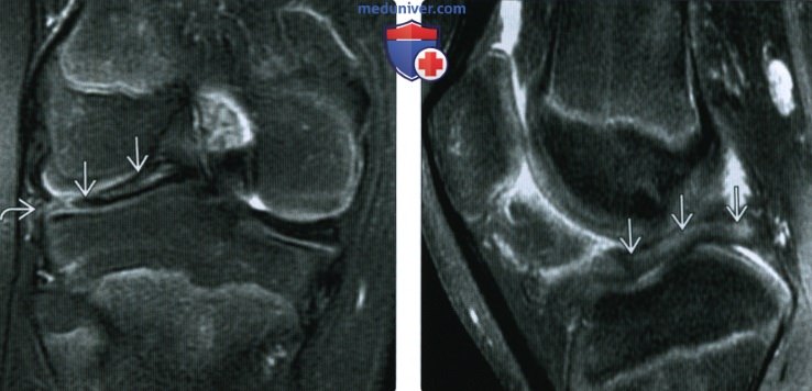 МРТ при дискоидном мениске коленного сустава