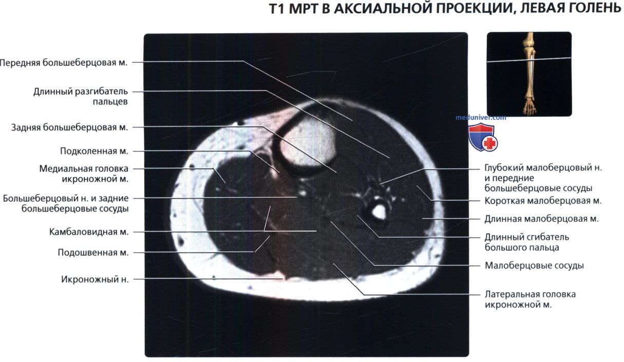 МРТ голени в аксиальной проекции в норме