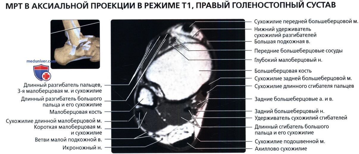 МРТ голеностопного сустава в аксиальной проекции в норме