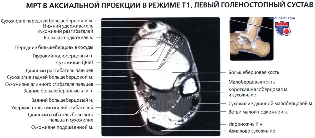 МРТ голеностопного сустава в аксиальной проекции в норме