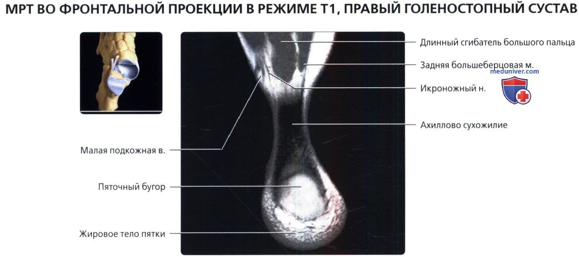 МРТ голеностопного сустава во фронтальной проекции в норме