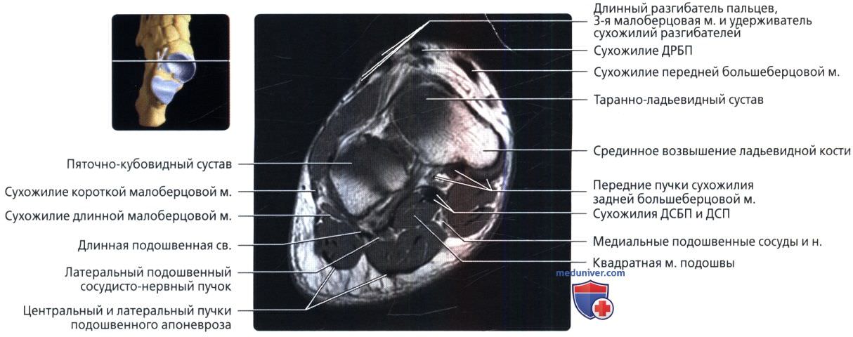 МРТ голеностопного сустава во фронтальной проекции в норме