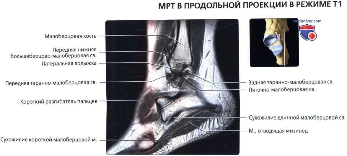 МРТ голеностопного сустава в продольной проекции в норме