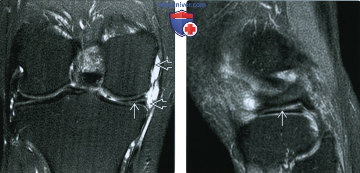 МРТ при горизонтальном разрыве мениска коленного сустава