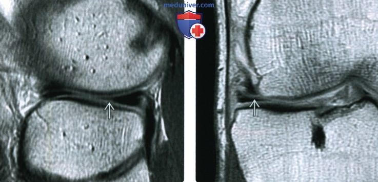 МРТ при горизонтальном разрыве мениска коленного сустава