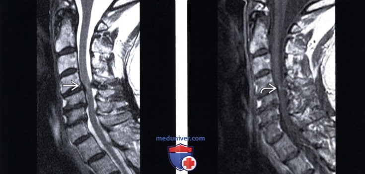 МРТ грыжи межпозвонкового диска шейного отдела позвоночника
