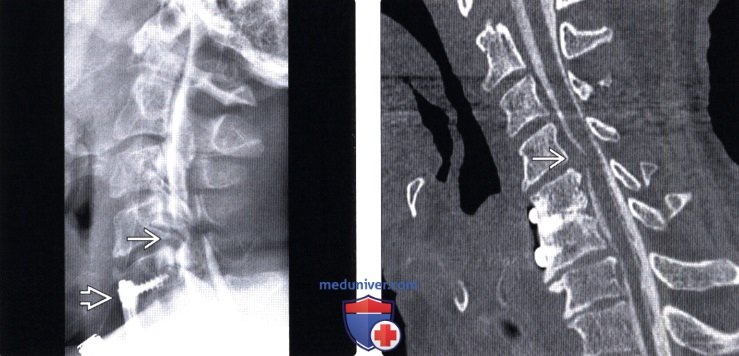 Рентгенограмма, миелограмма, КТ грыжи межпозвонкового диска шейного отдела позвоночника