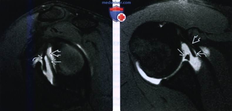 МРТ губы плечевого сустава в норме