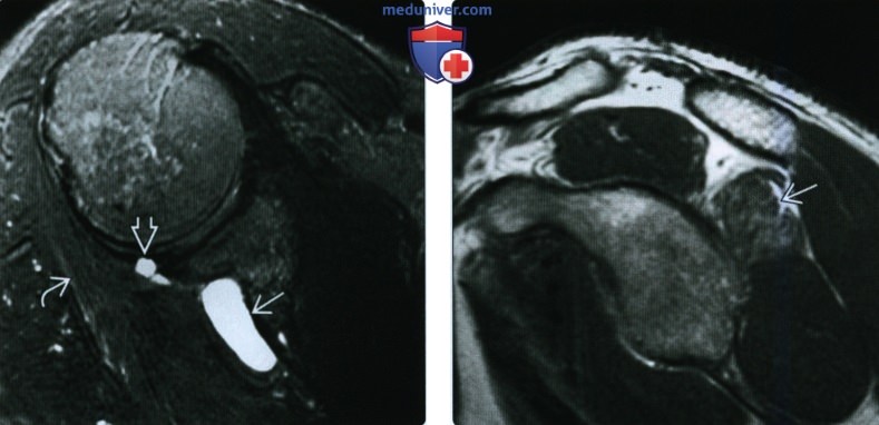 МРТ при надлопаточной кисте и кисте большой вырезки лопатки
