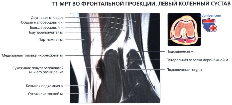 МРТ коленного сустава во фронтальной проекции в норме