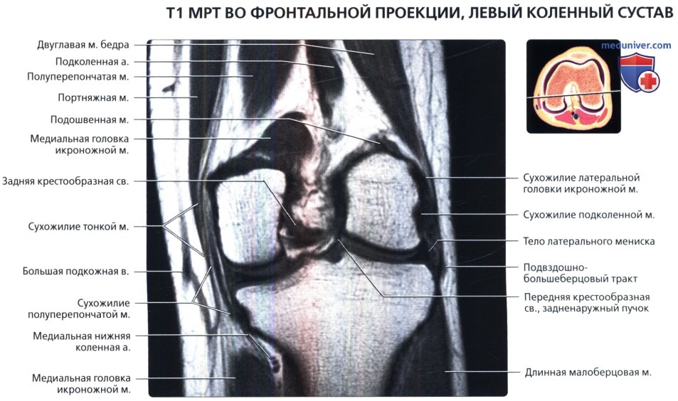 МРТ коленного сустава во фронтальной проекции в норме