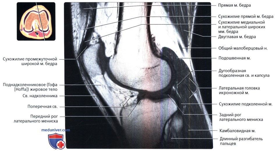 МРТ коленного сустава в продольной проекции в норме