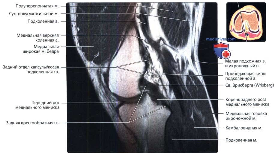 МРТ коленного сустава в продольной проекции в норме