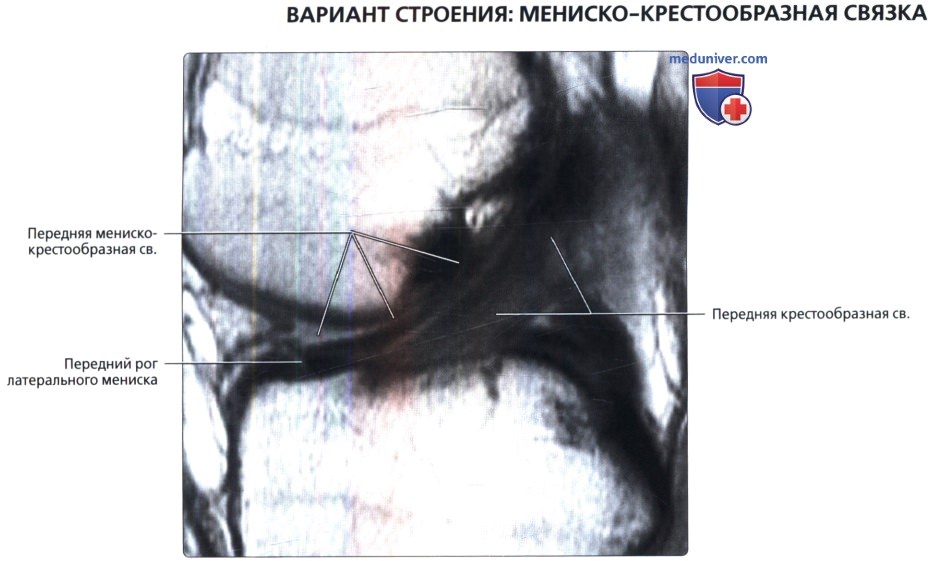МРТ крестообразных связок коленного сустава в норме