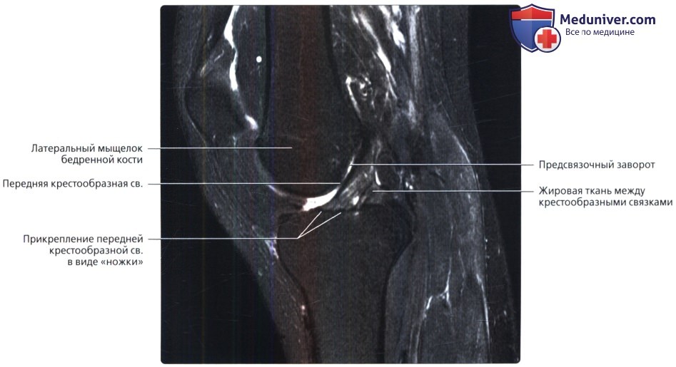 Разрыв передней крестообразной связки коленного сустава мрт thumbnail