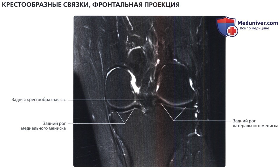 МРТ крестообразных связок коленного сустава в норме