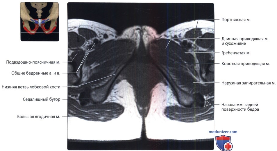 МРТ лонного сочленения и приводящих мышц в аксиальной проекции в норме