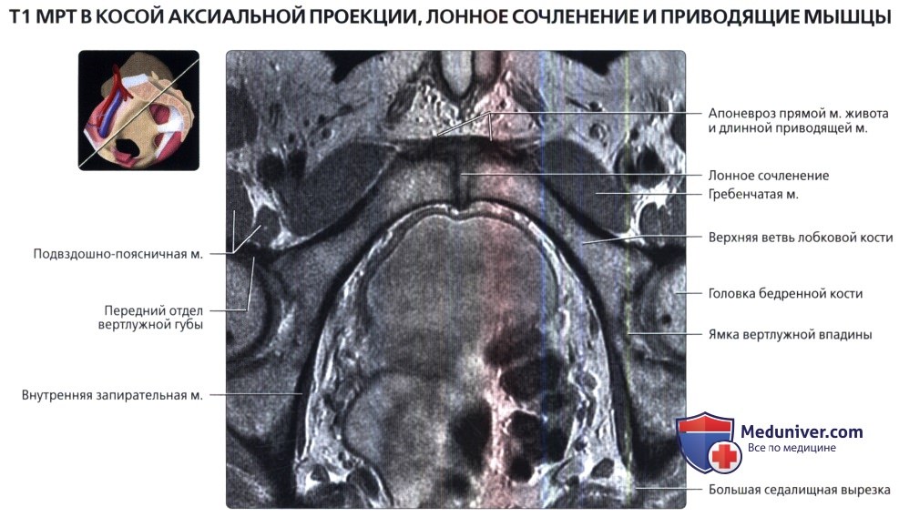 МРТ лонного сочленения и приводящих мышц в косой аксиальной проекции в норме