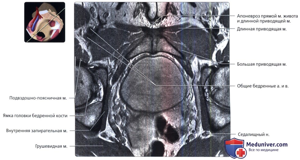 МРТ лонного сочленения и приводящих мышц в косой аксиальной проекции в норме