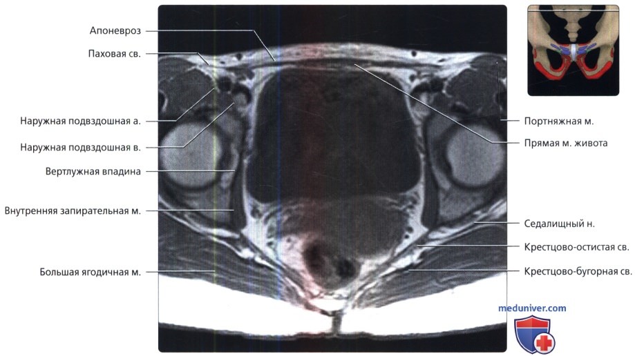 МРТ лонного сочленения и приводящих мышц в аксиальной проекции в норме