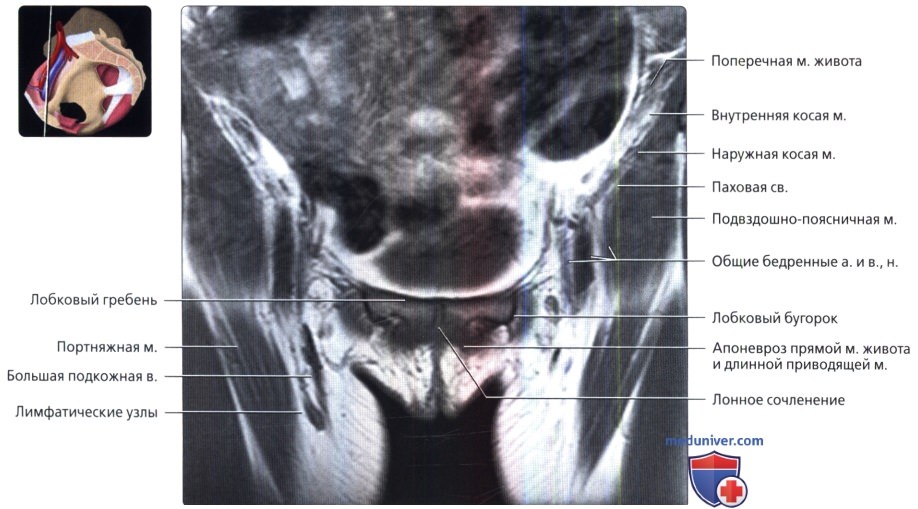 МРТ лонного сочленения и приводящих мышц во фронтальной проекции в норме