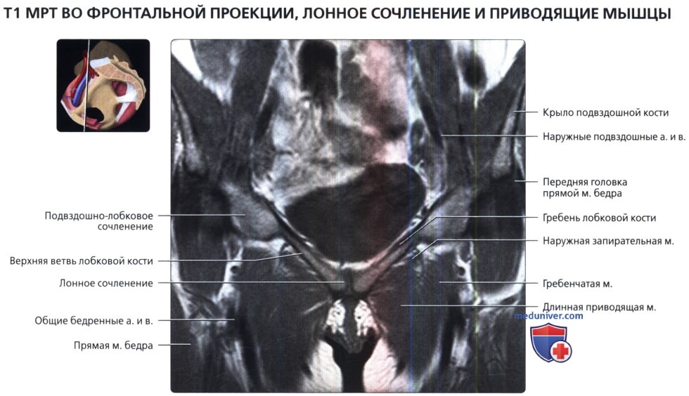 МРТ лонного сочленения и приводящих мышц во фронтальной проекции в норме