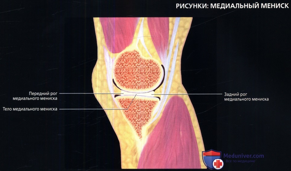 МРТ медиального мениска коленного сустава в норме