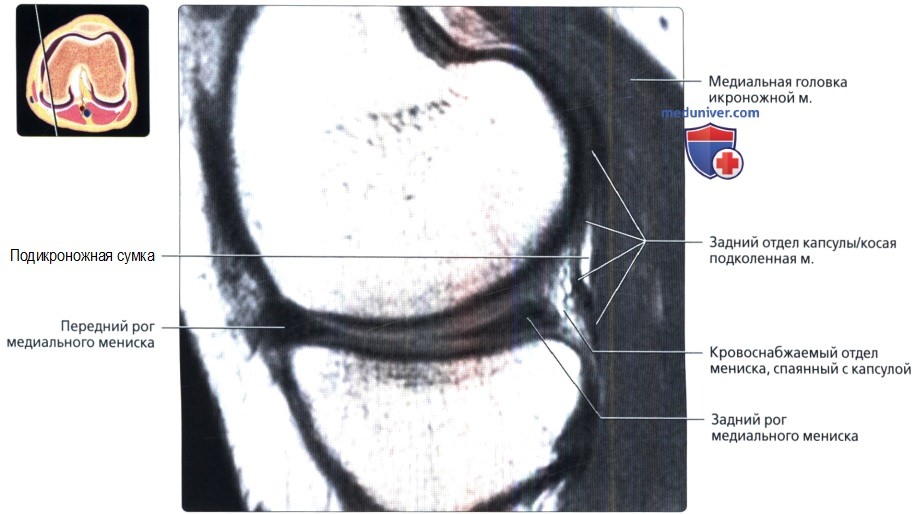Передний Рог латерального мениска мрт. МР картина дегенеративных изменений менисков. Дегенеративные изменения заднего рога медиального мениска 2
