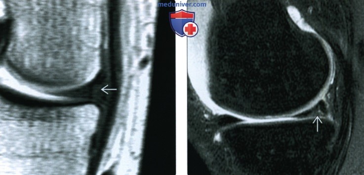 МРТ мениска коленного сустава после операции