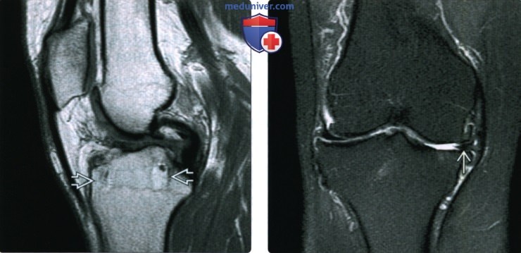 МРТ мениска коленного сустава после операции